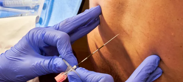 Péridurale à la maternité : déroulé, bénéfices, limites et sécurité